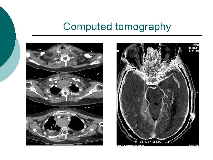 Computed tomography 