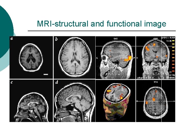MRI-structural and functional image 