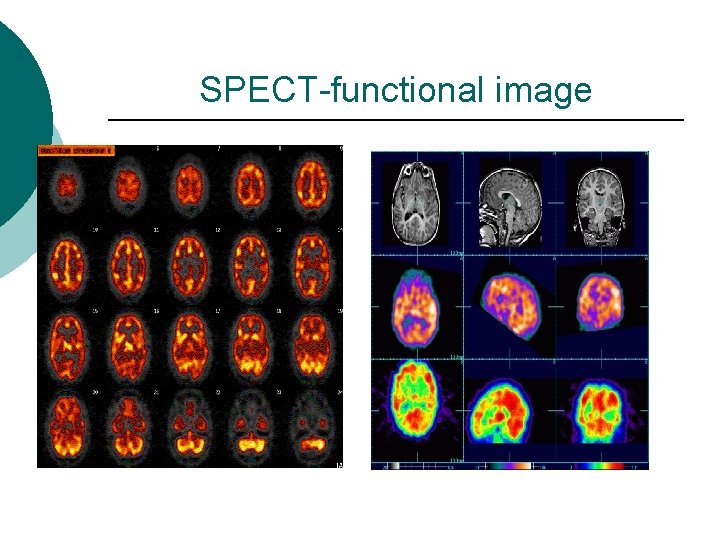 SPECT-functional image 