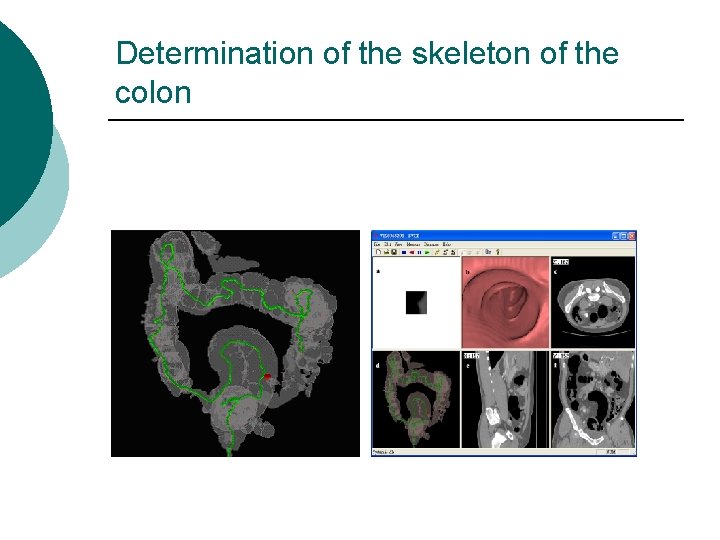 Determination of the skeleton of the colon 