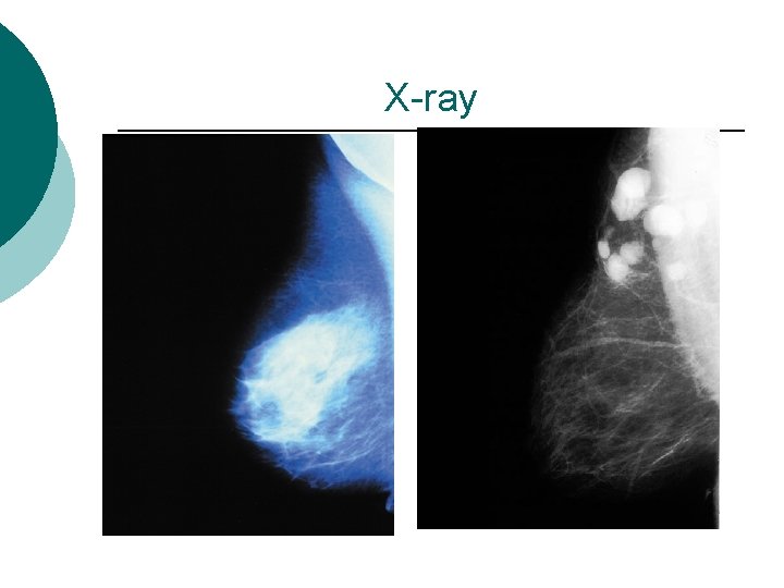 X-ray 