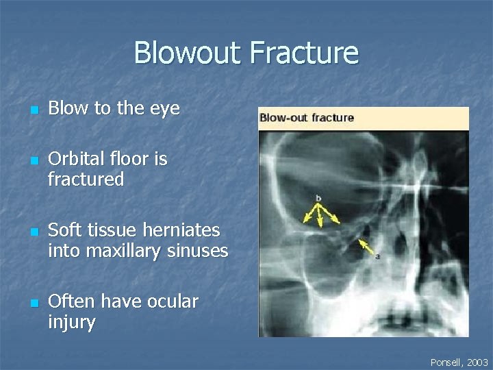 Blowout Fracture n n Blow to the eye Orbital floor is fractured Soft tissue