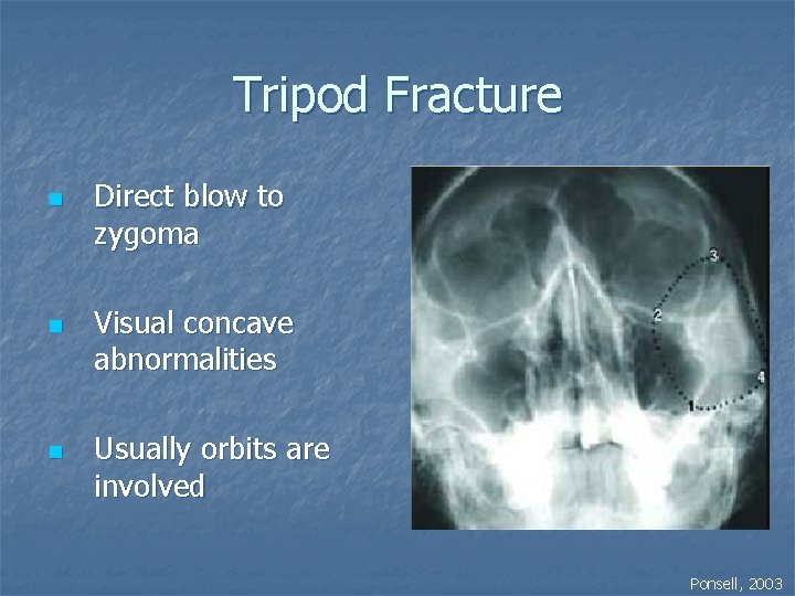 Tripod Fracture n n n Direct blow to zygoma Visual concave abnormalities Usually orbits