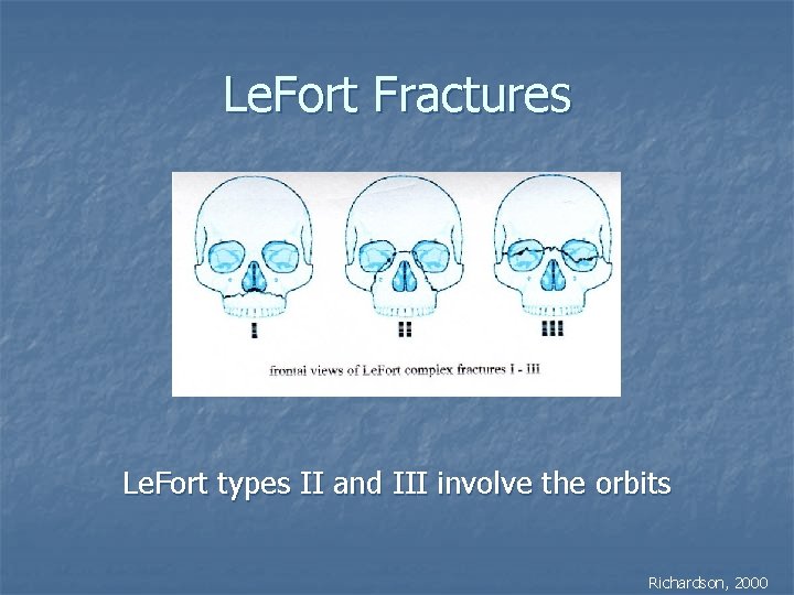 Le. Fort Fractures Le. Fort types II and III involve the orbits Richardson, 2000