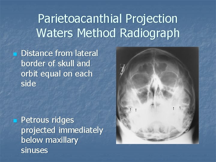 Parietoacanthial Projection Waters Method Radiograph n n Distance from lateral border of skull and