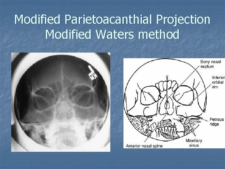 Modified Parietoacanthial Projection Modified Waters method 