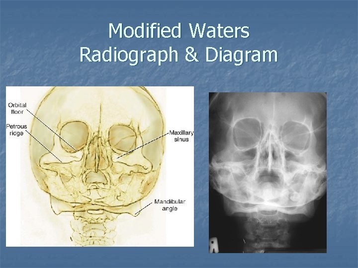 Modified Waters Radiograph & Diagram 