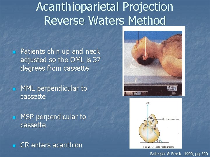 Acanthioparietal Projection Reverse Waters Method n n Patients chin up and neck adjusted so