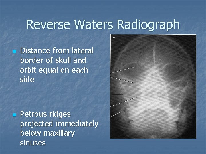 Reverse Waters Radiograph n n Distance from lateral border of skull and orbit equal