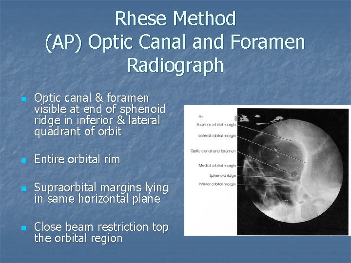 Rhese Method (AP) Optic Canal and Foramen Radiograph n Optic canal & foramen visible