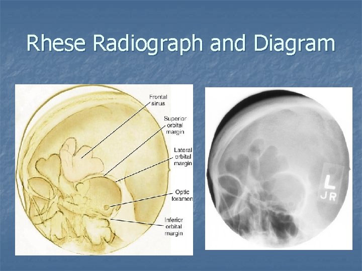 Rhese Radiograph and Diagram 