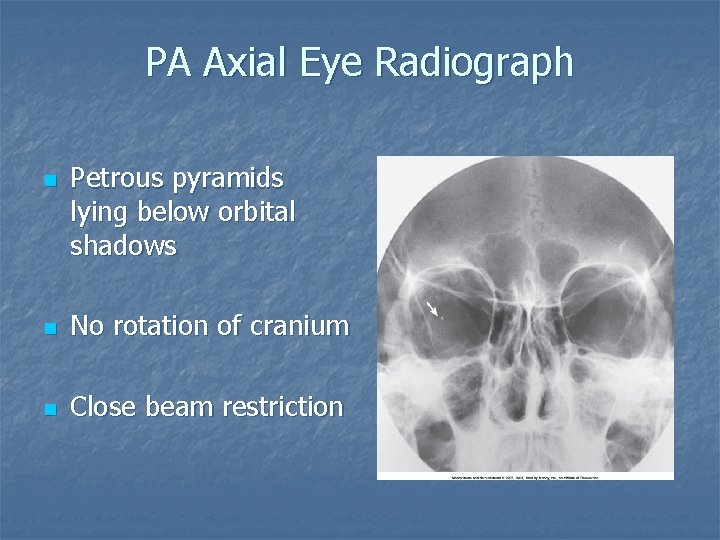 PA Axial Eye Radiograph n Petrous pyramids lying below orbital shadows n No rotation