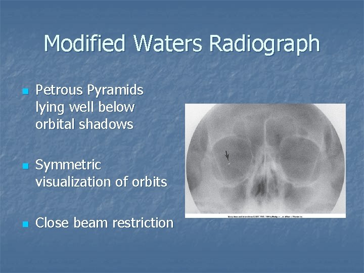 Modified Waters Radiograph n n n Petrous Pyramids lying well below orbital shadows Symmetric