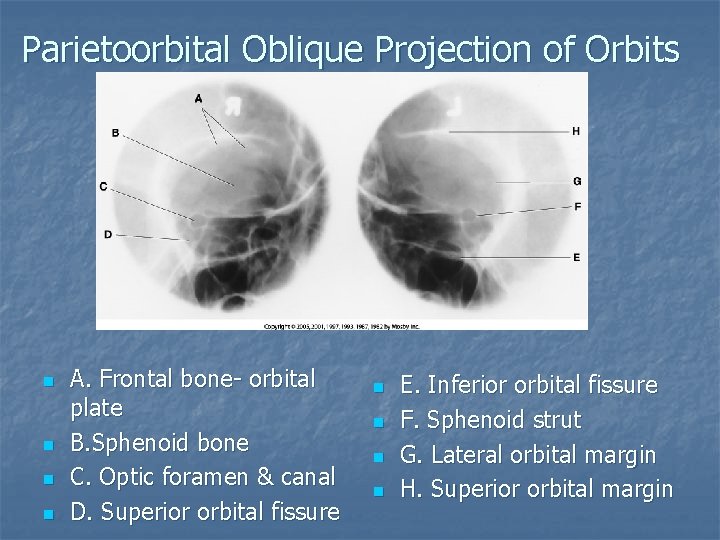Parietoorbital Oblique Projection of Orbits n n A. Frontal bone- orbital plate B. Sphenoid