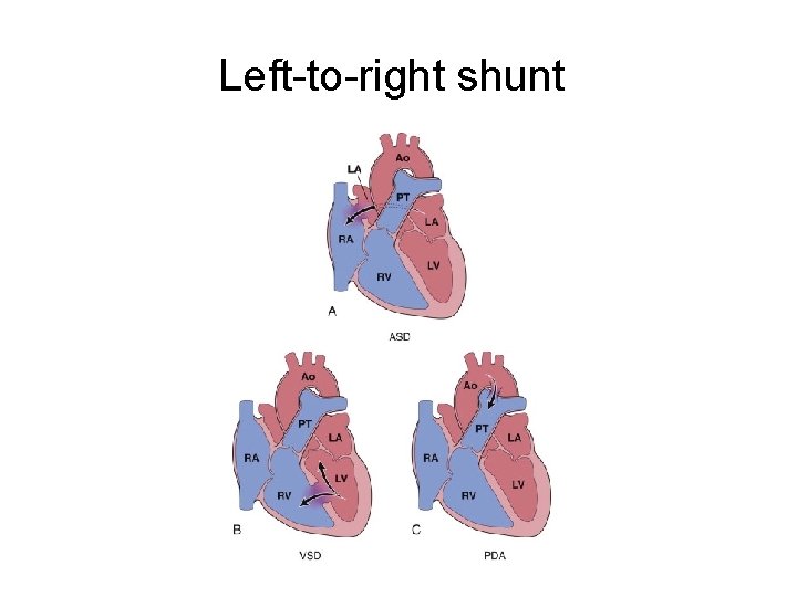 Left-to-right shunt 