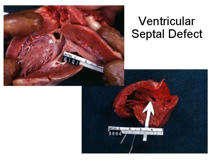 Ventricular Septal Defect 