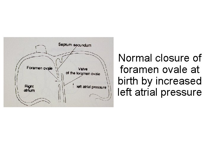 Normal closure of foramen ovale at birth by increased left atrial pressure 