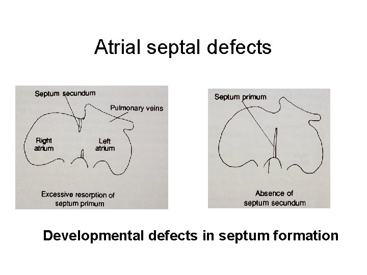 Atrial septal defects Developmental defects in septum formation 
