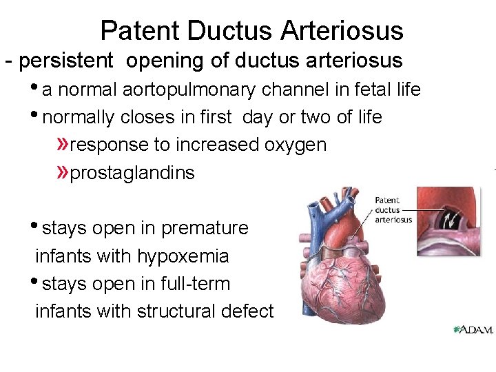 Patent Ductus Arteriosus - persistent opening of ductus arteriosus • a normal aortopulmonary channel