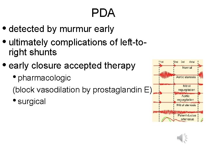 PDA • detected by murmur early • ultimately complications of left-toright shunts • early