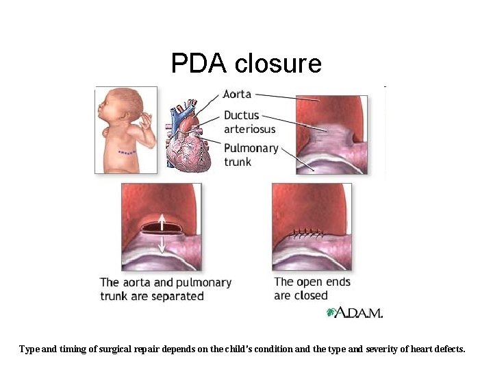 PDA closure Type and timing of surgical repair depends on the child's condition and