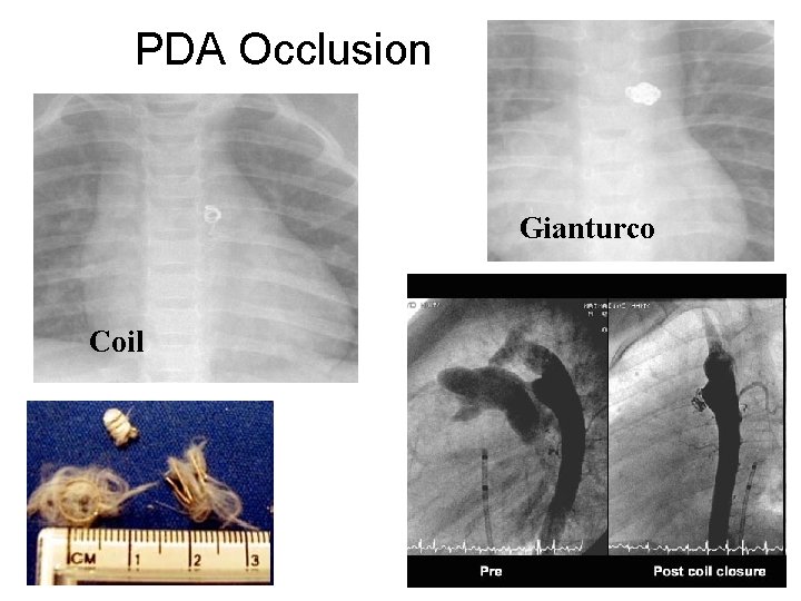 PDA Occlusion Gianturco Coil 