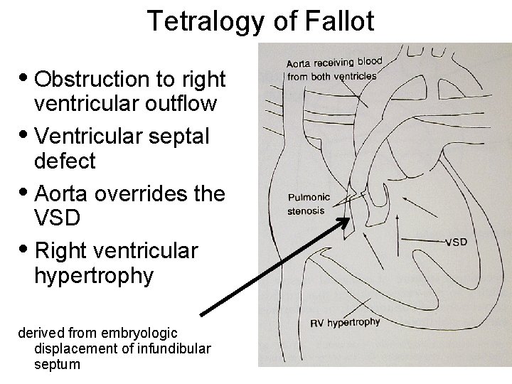 Tetralogy of Fallot • Obstruction to right ventricular outflow • Ventricular septal defect •