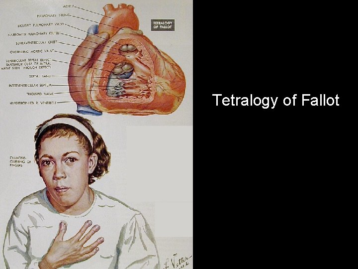 Tetralogy of Fallot 