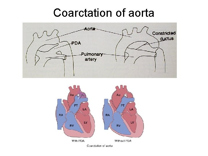Coarctation of aorta 