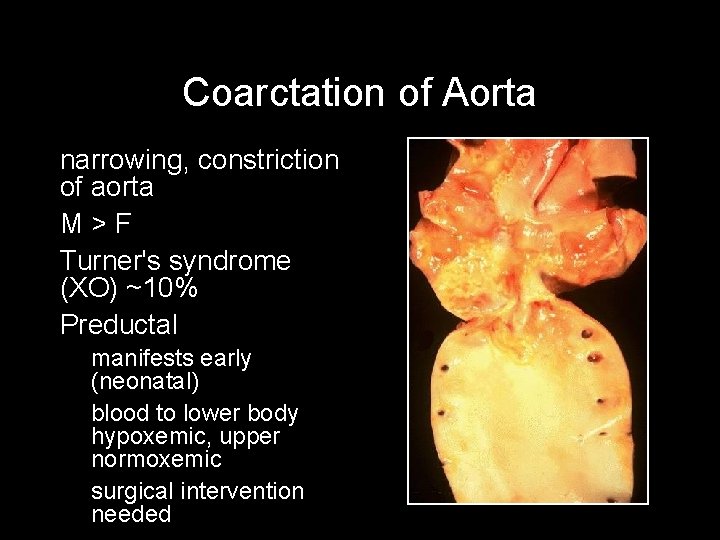 Coarctation of Aorta • narrowing, constriction • • • of aorta M>F Turner's syndrome