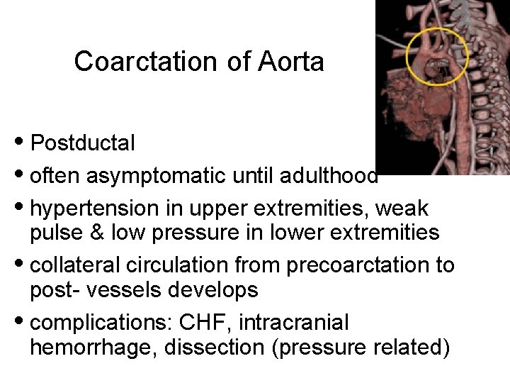Coarctation of Aorta • Postductal • often asymptomatic until adulthood • hypertension in upper