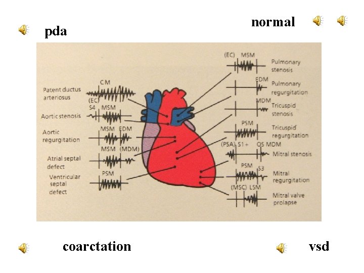 pda coarctation normal vsd 