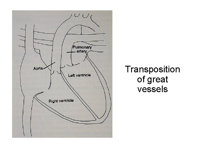 Transposition of great vessels 