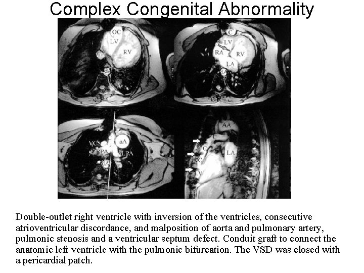 Complex Congenital Abnormality Double-outlet right ventricle with inversion of the ventricles, consecutive atrioventricular discordance,