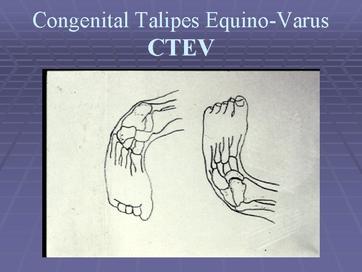 Congenital Talipes Equino-Varus CTEV 