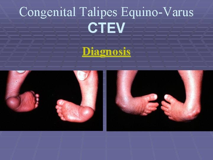 Congenital Talipes Equino-Varus CTEV Diagnosis 