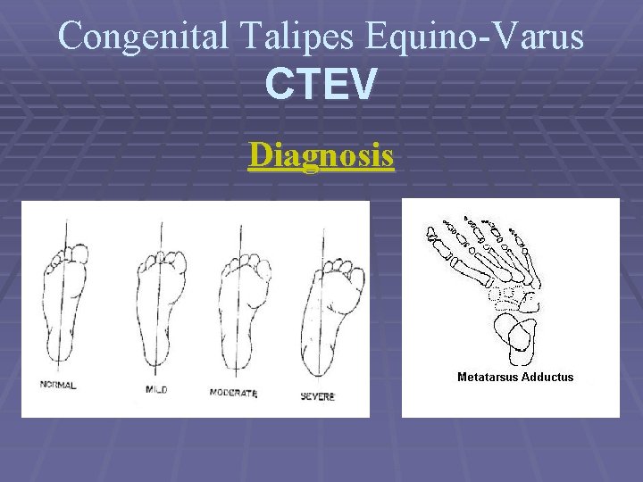 Congenital Talipes Equino-Varus CTEV Diagnosis 