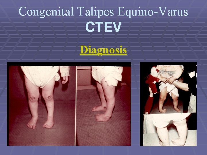 Congenital Talipes Equino-Varus CTEV Diagnosis 