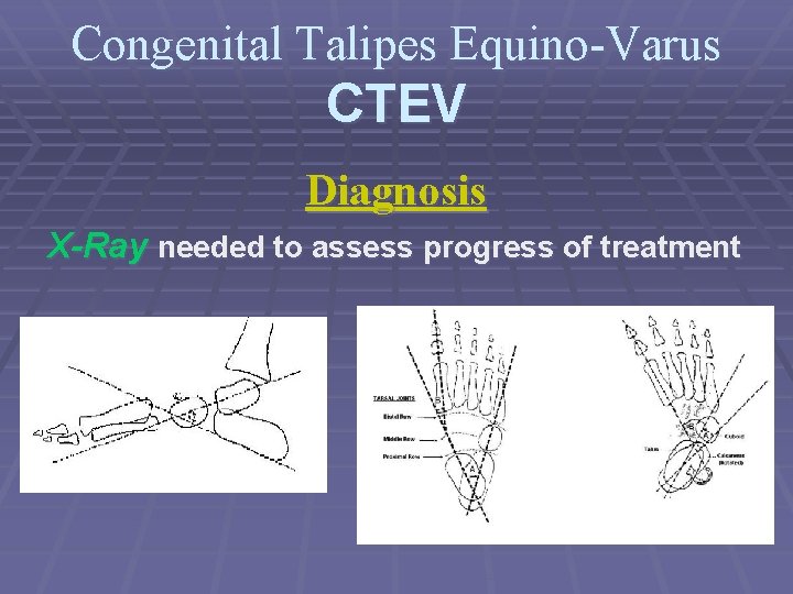 Congenital Talipes Equino-Varus CTEV Diagnosis X-Ray needed to assess progress of treatment 