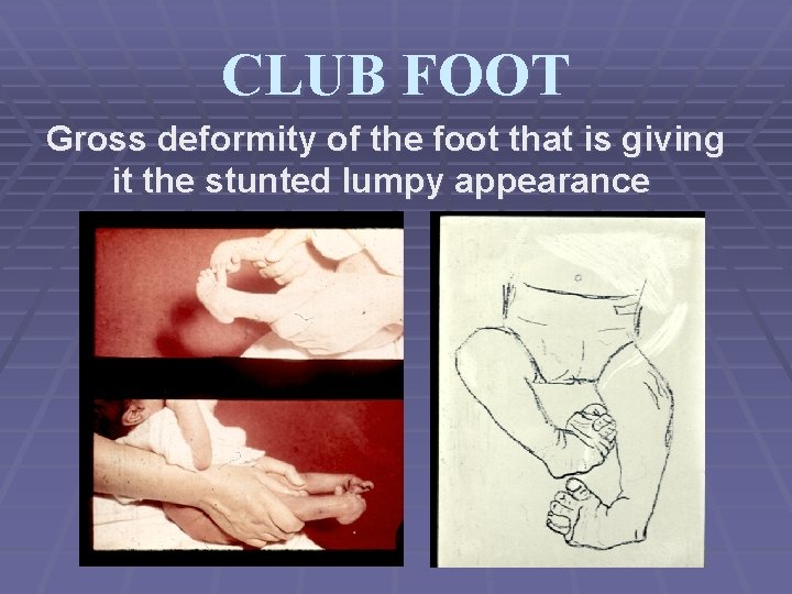 CLUB FOOT Gross deformity of the foot that is giving it the stunted lumpy