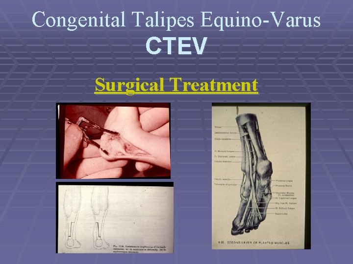 Congenital Talipes Equino-Varus CTEV Surgical Treatment 