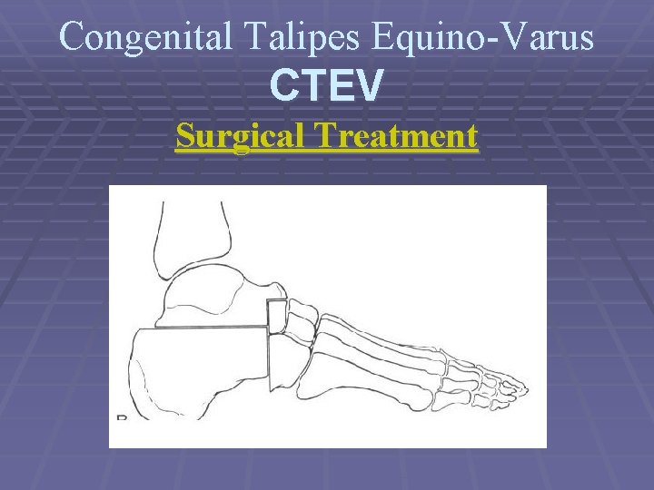 Congenital Talipes Equino-Varus CTEV Surgical Treatment 