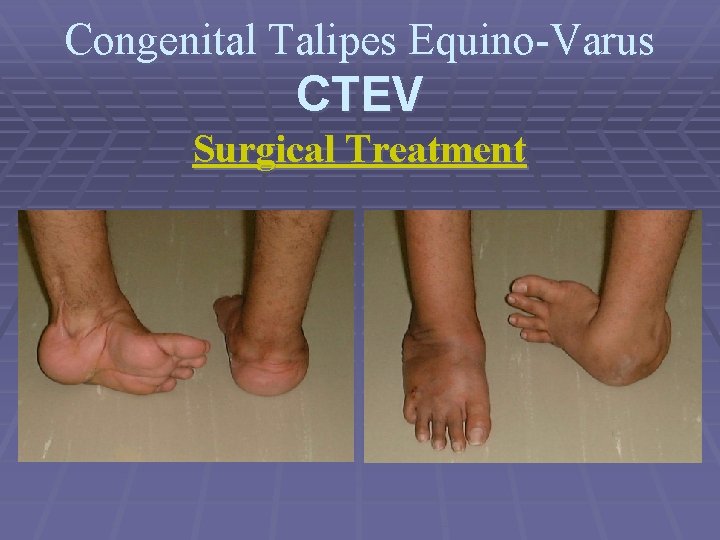 Congenital Talipes Equino-Varus CTEV Surgical Treatment 