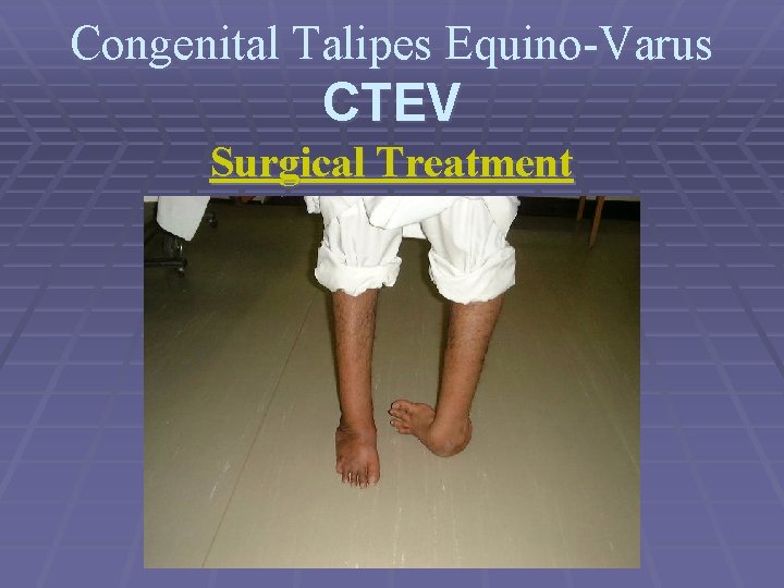 Congenital Talipes Equino-Varus CTEV Surgical Treatment 