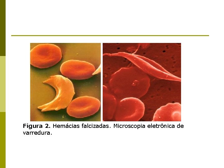 Figura 2. Hemácias falcizadas. Microscopia eletrônica de varredura. 