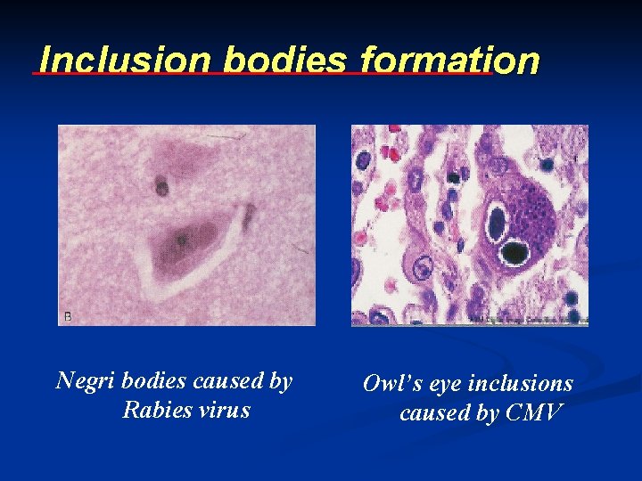 Inclusion bodies formation Negri bodies caused by Rabies virus Owl’s eye inclusions caused by