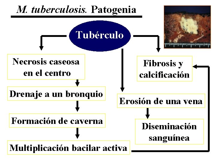 M. tuberculosis. Patogenia Tubérculo Necrosis caseosa en el centro Drenaje a un bronquio Fibrosis