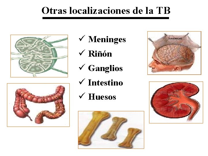 Otras localizaciones de la TB ü Meninges ü Riñón ü Ganglios ü Intestino ü