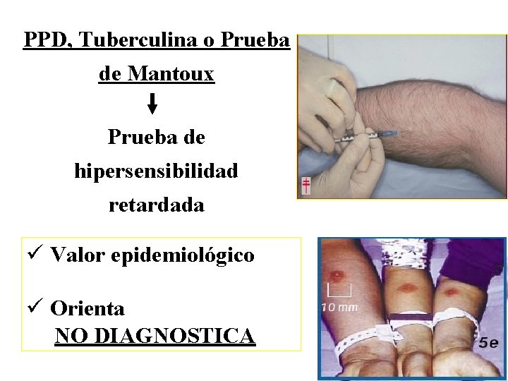 PPD, Tuberculina o Prueba de Mantoux Prueba de hipersensibilidad retardada ü Valor epidemiológico ü