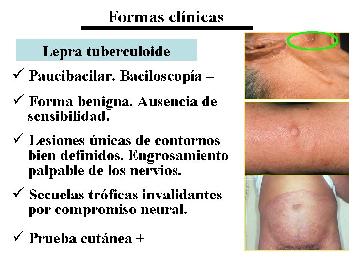 Formas clínicas Lepra tuberculoide ü Paucibacilar. Baciloscopía – ü Forma benigna. Ausencia de sensibilidad.